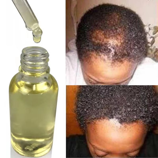 Magical Hair Growth Oil,Regrowth Serum,Hair Loss, Men Hairloss, Women Hair Loss, Kids Hairless Infused Jamaican Black Castor Oil